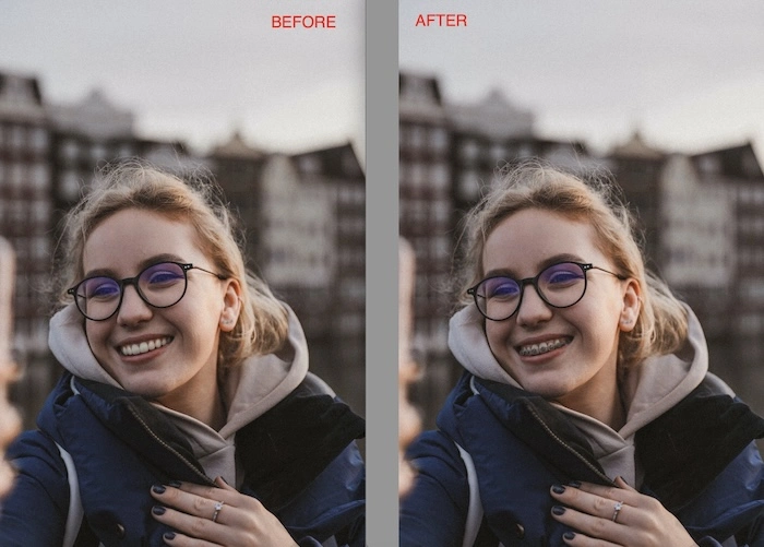 Clear Braces Photos with Evoto Filter