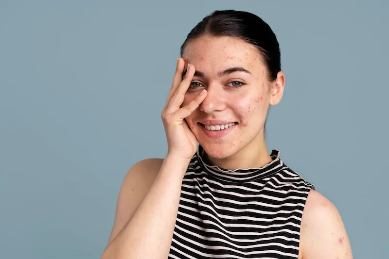 Face Freckles and Acne Removal