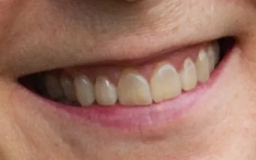 Black Friday Portrati Teeth Retouching Before