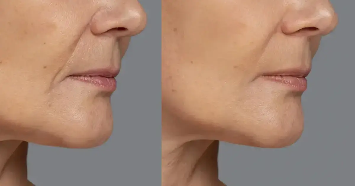 How to Get Rid of Nasolabial Folds in Photos