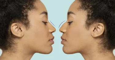 Evoto AI Nose Shaper Enhances Facial Features