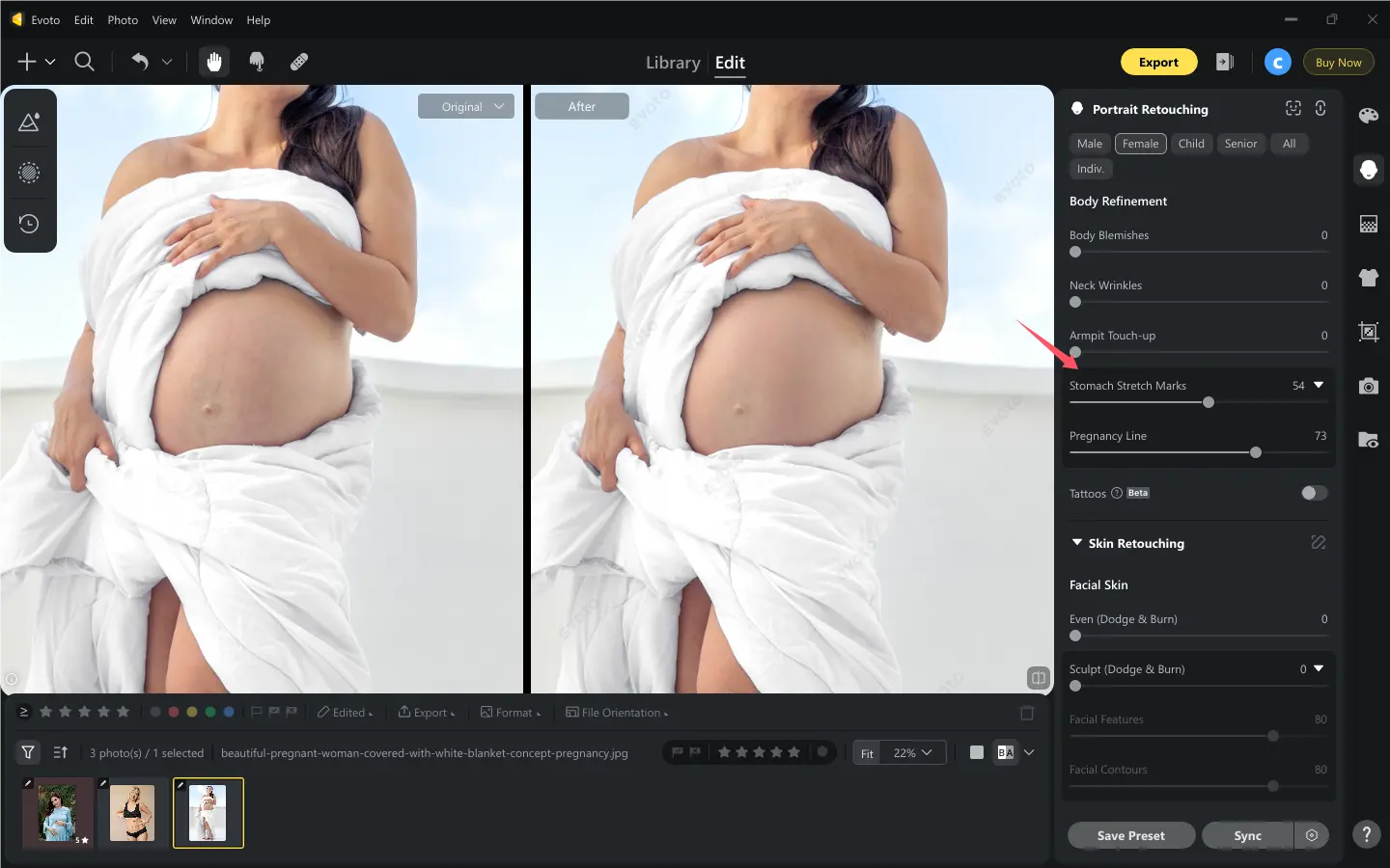 Remove Stretch Marks Supprimer les vergetures grossesse avec Evoto