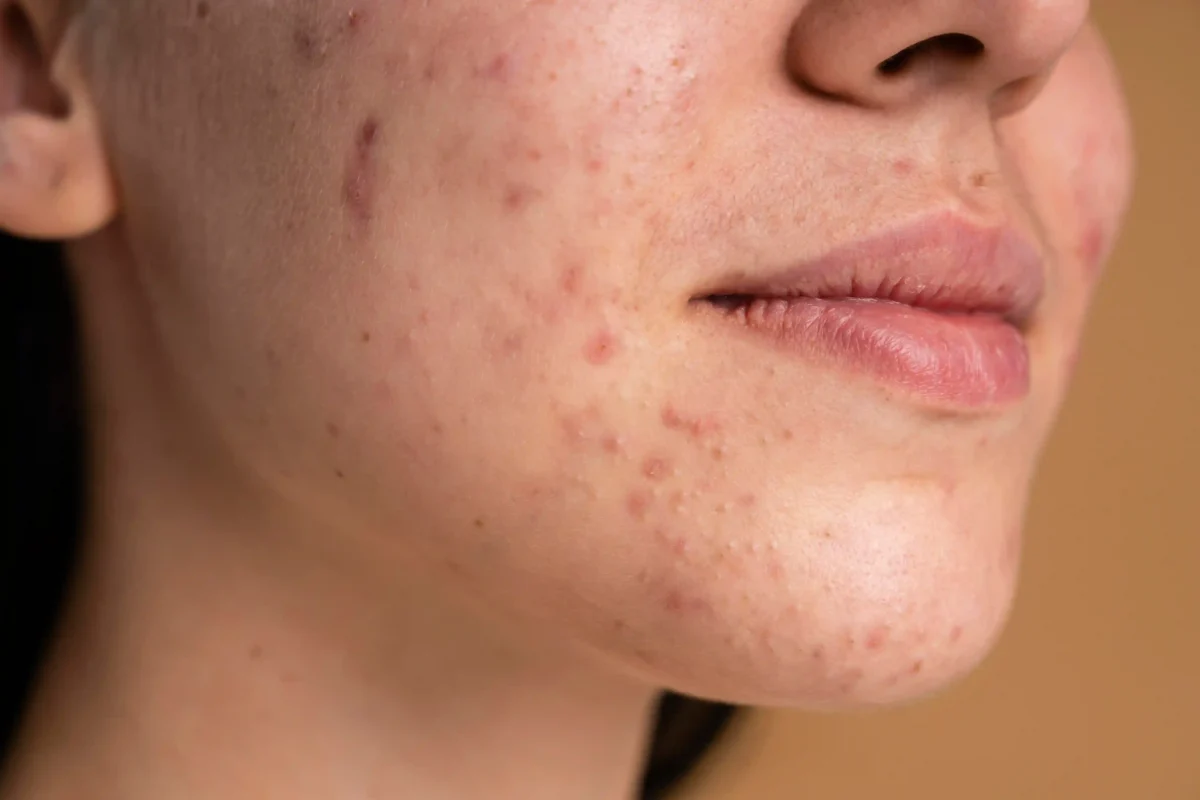 acne smooth acne skin