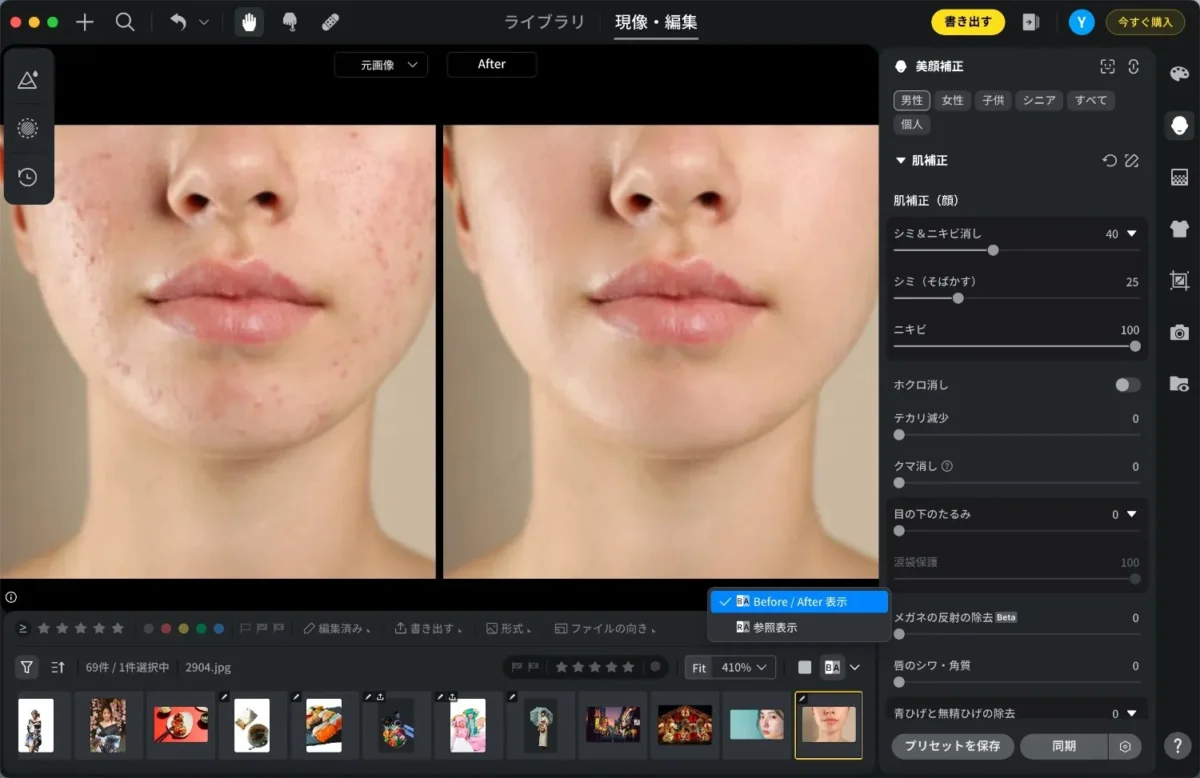 evotoニキビ除去前後比較