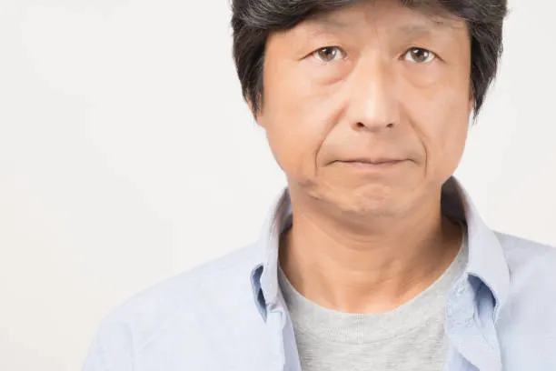 remove nasolabial fold before ほうれい線消し前