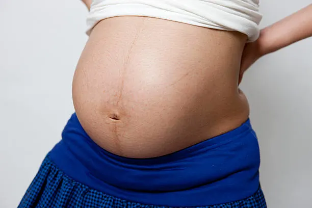 remove pregnancy line before 妊娠線消し前