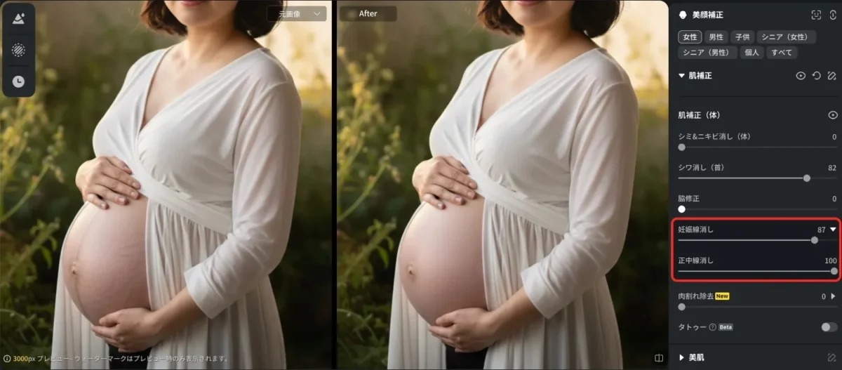 evoto 妊娠線・ストレッチマーク消し