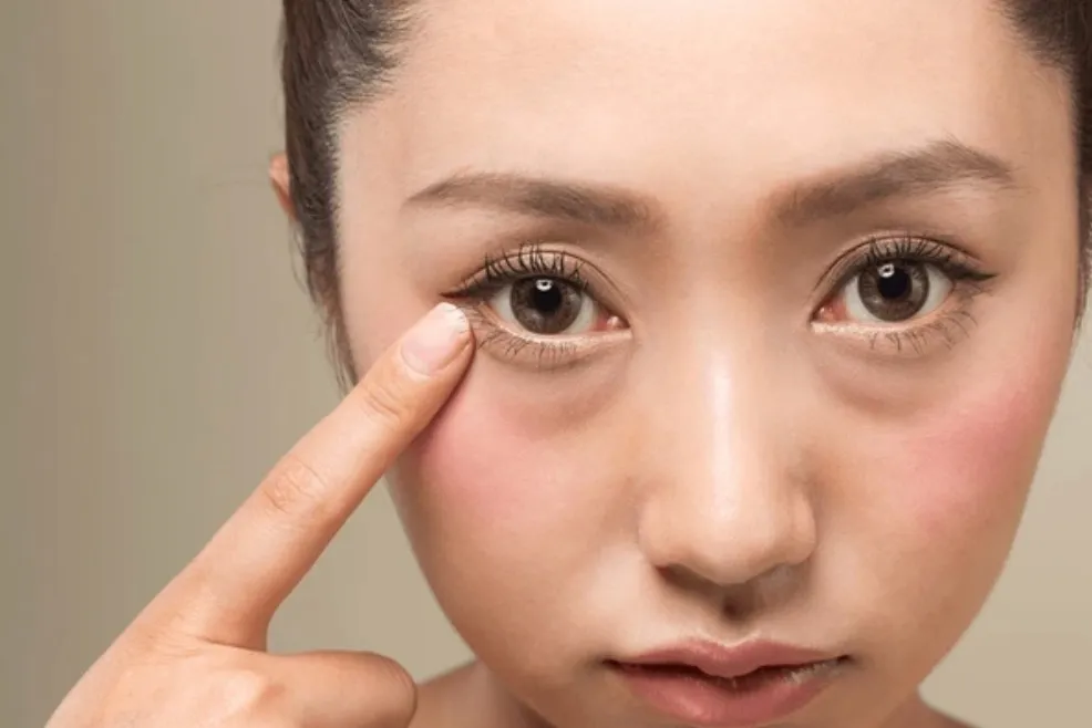 before remove dark circles under eyes 目の下のクマを消す前の状態