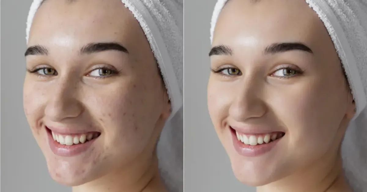 Blemish Removal Photo Editor