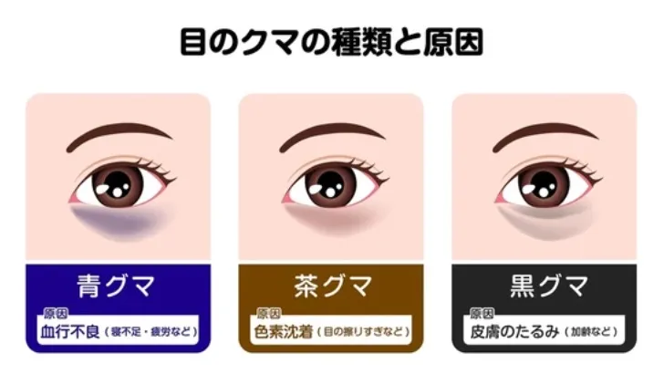 types-and-causes-of-dark-circles-under-the-eyes 目の下のクマの種類と原因
