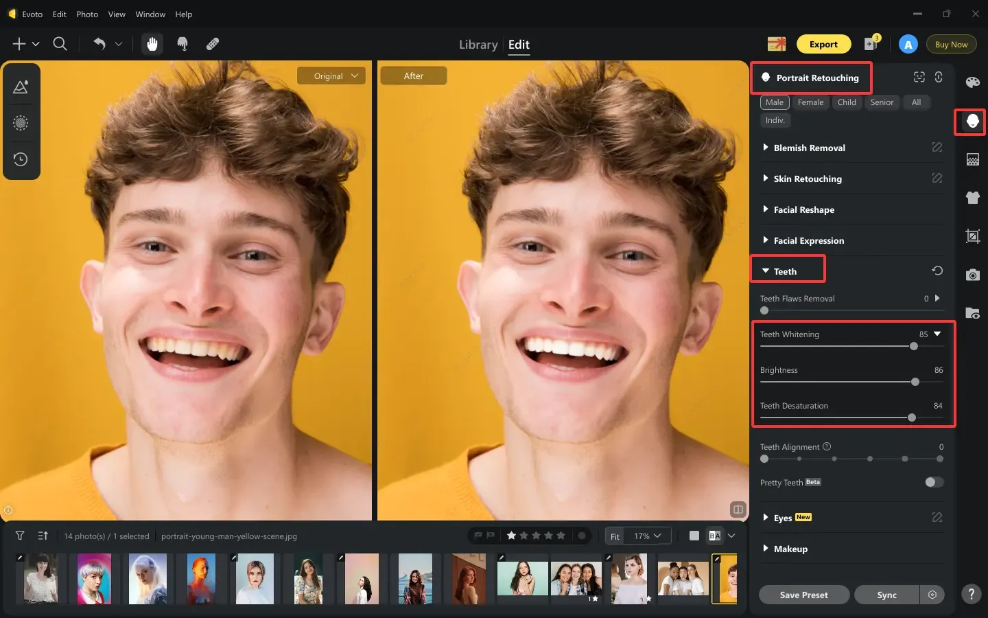 Before After Photo of Teeth Whitening Before-After Photo of Teeth Whitening