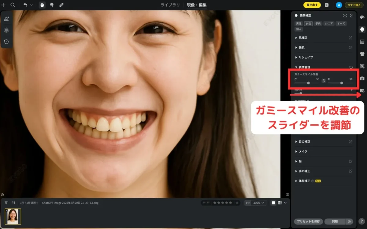 ガミースマイル改善のスライダーを左右で調整