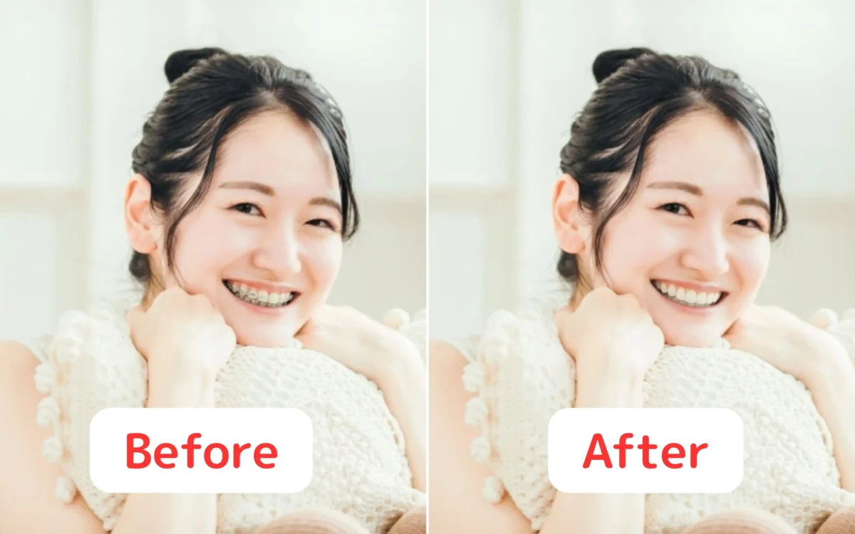 矯正器具が消えたBeforeとAfterを並べた比較画像