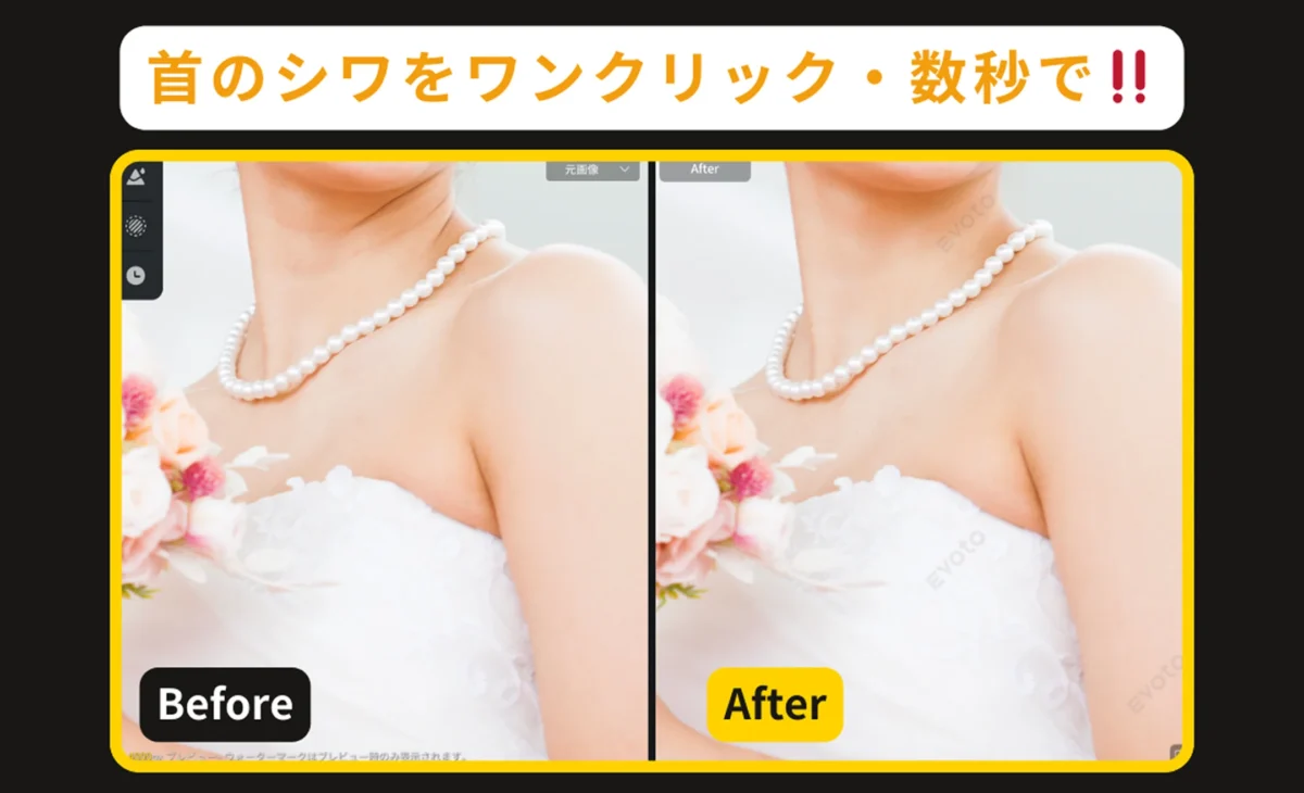 Evotoで実現する首のシワ消し ビフォー・アフター比較