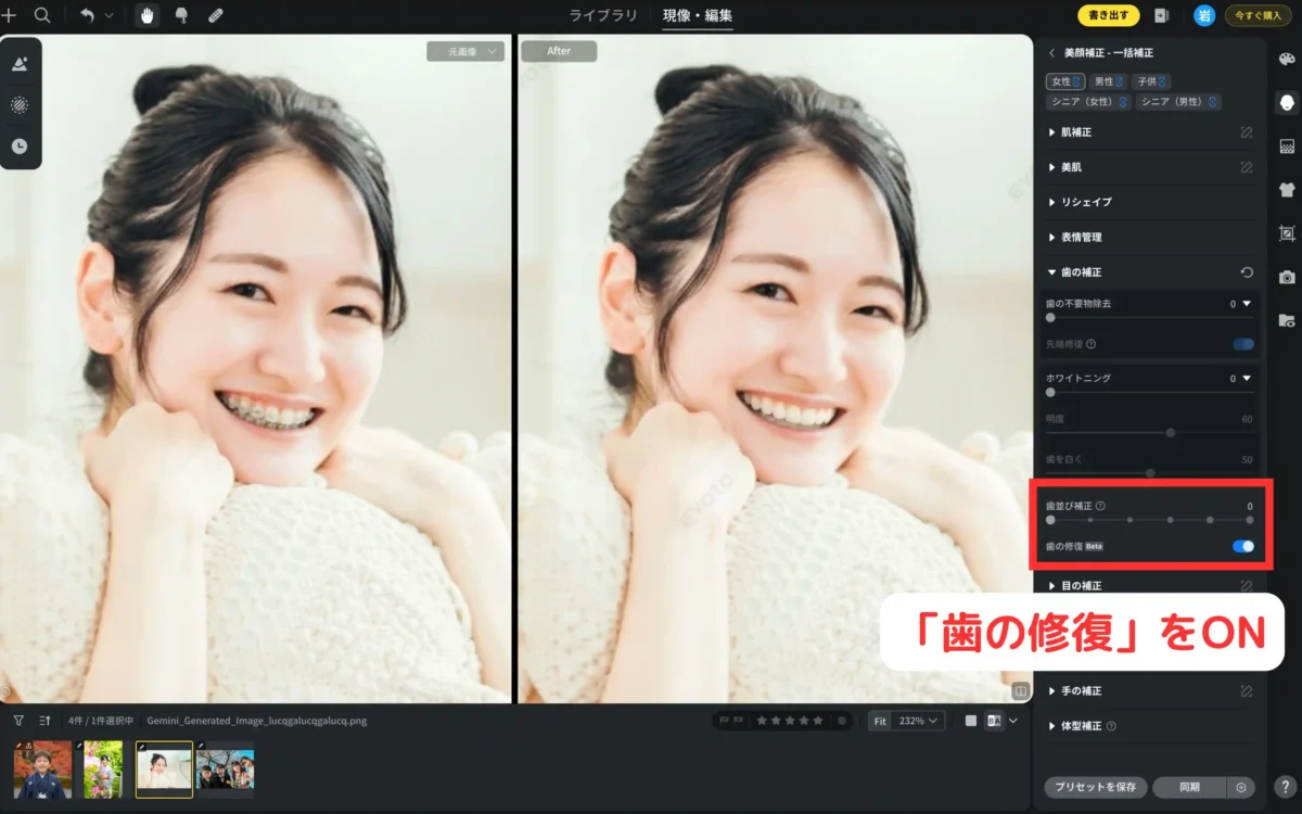歯の修復をONにして矯正器具が消えている編集画面