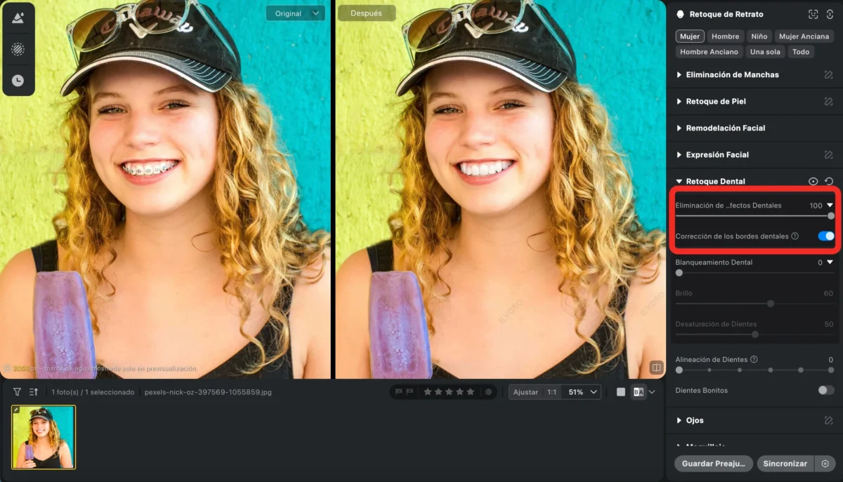 Refinar la Sonrisa Opcional