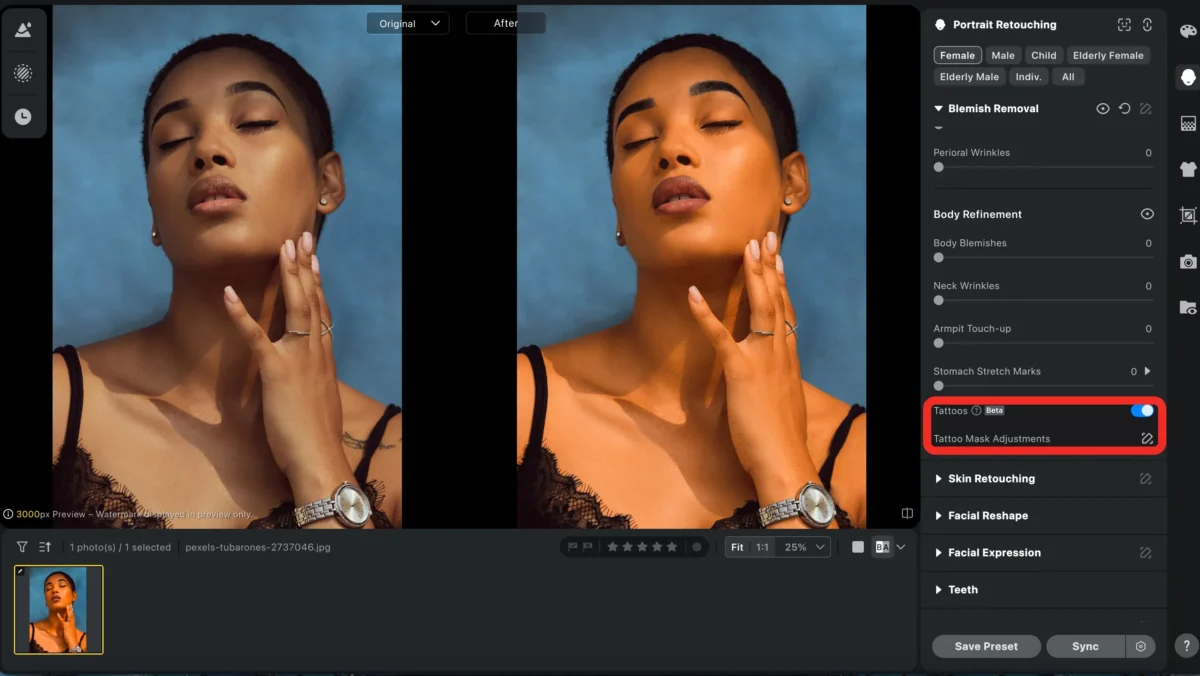 tattos removal