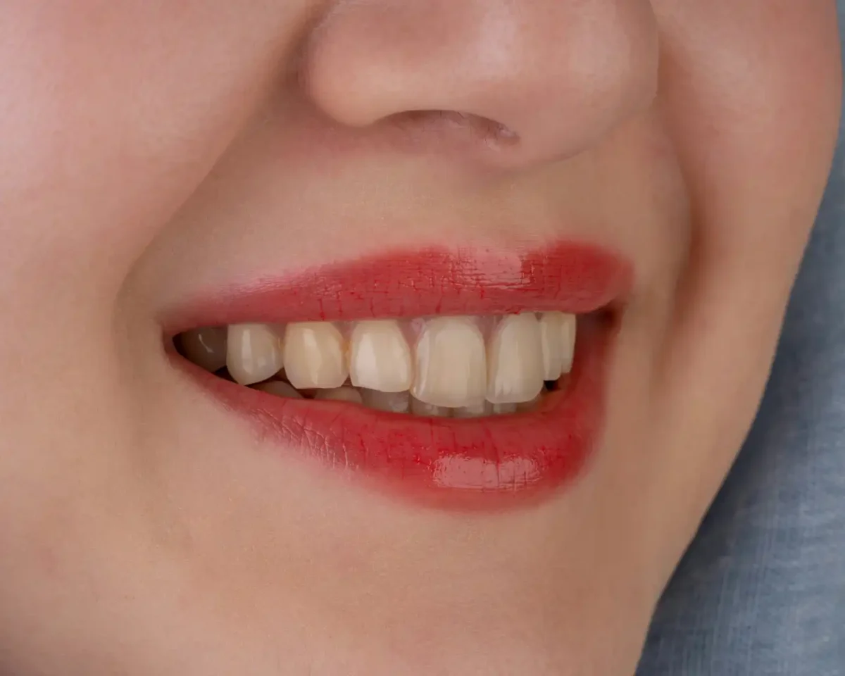 teeth whitening 2 AI 치아 보정 전 노란 치아와 착색 상태를 보여주는 클로즈업 이미지