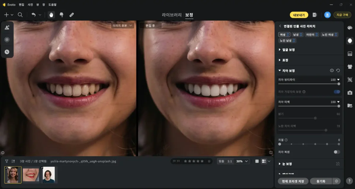 teeth whitening 6 voto AI 치아 보정 기능으로 노란 치아 제거와 미백 작업을 적용한 상세 전후 비교 화면