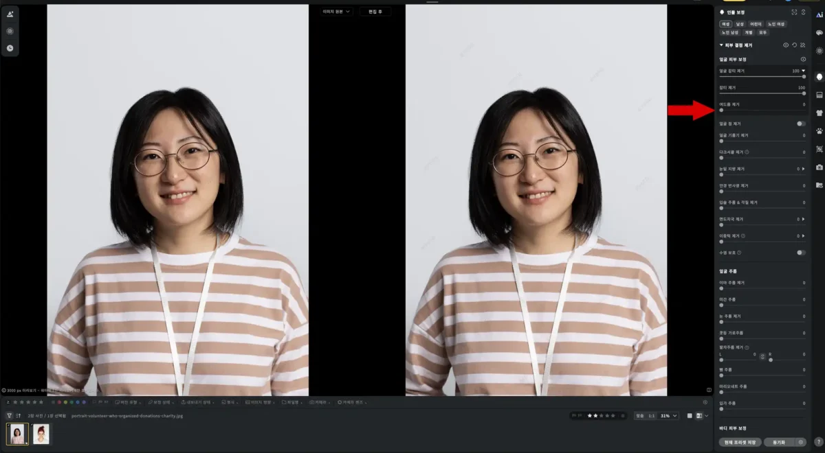Evoto 잡티 제거 여드름만 제거 예시