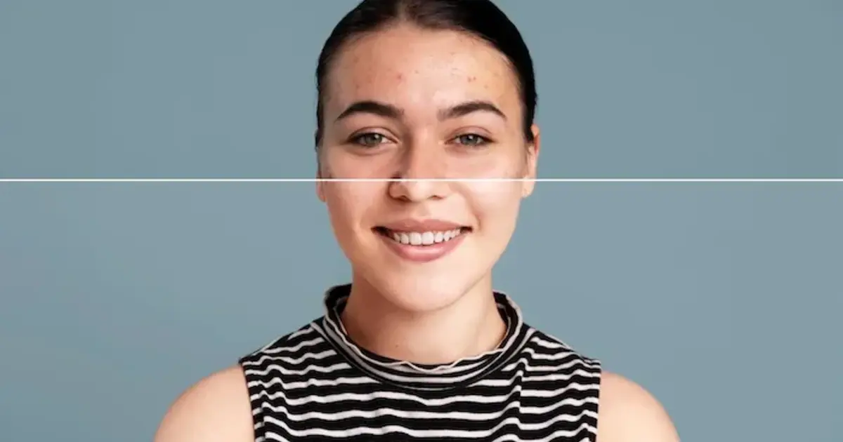 Guia Definitivo de Ferramenta de Remoção de Espinhas