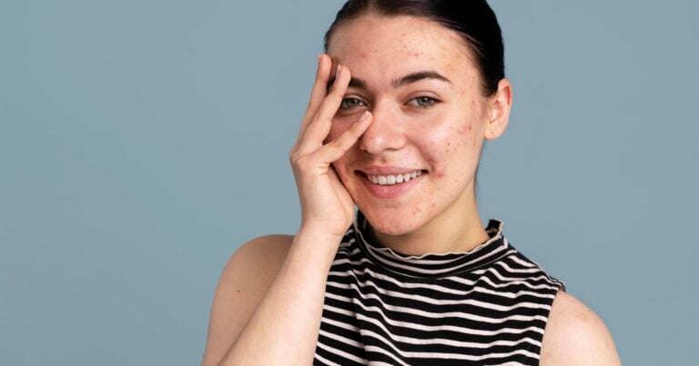 Como Remover Sardas e Acne do Rosto em Fotos