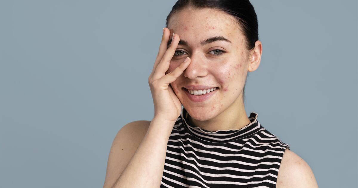 Como Remover Sardas do Rosto e Acne em Fotos