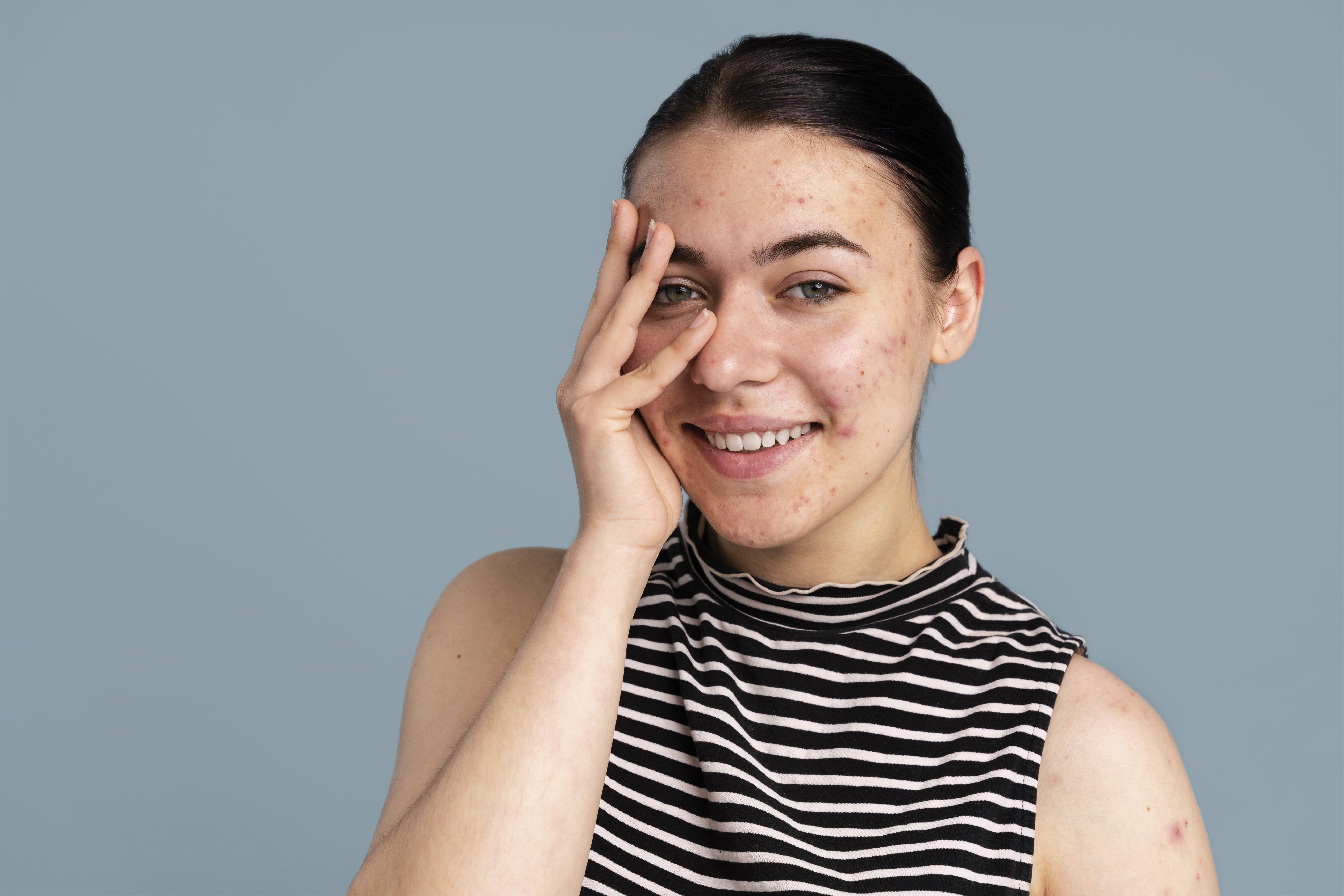 remoção de espinhas-antes