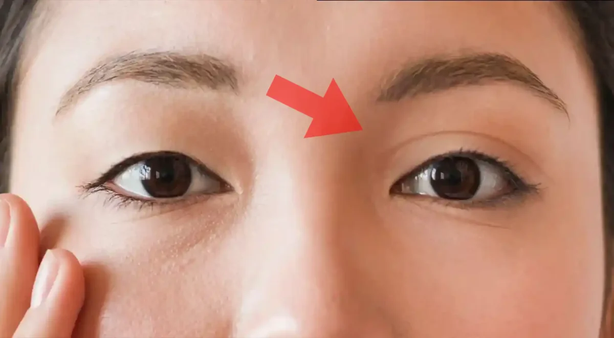 쌍꺼풀 전후 사진 예시