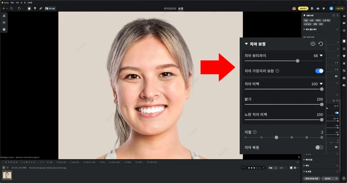 Evoto 치아 보정 2단계