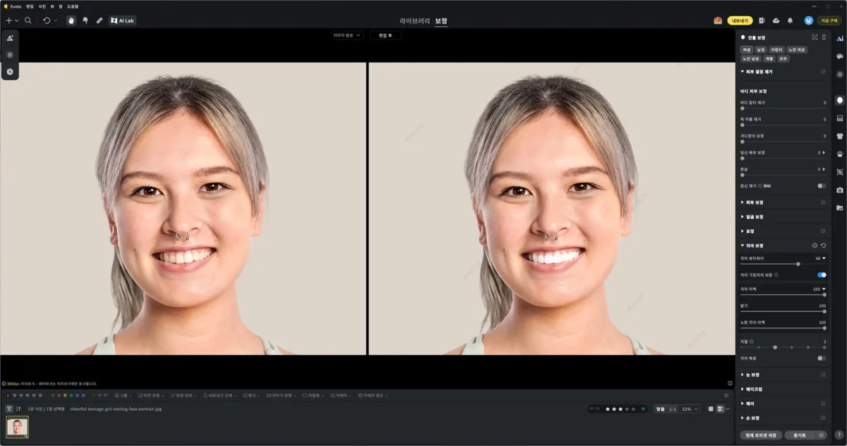 Evoto 치아 보정 전후 비교
