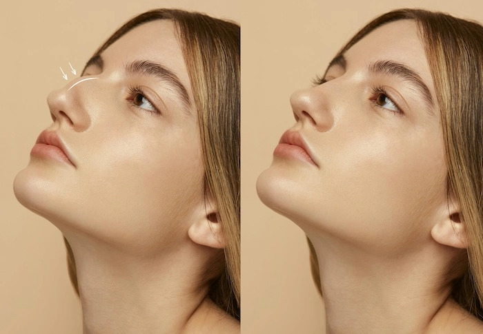 Exemplo de editor de nariz aplicado em retrato