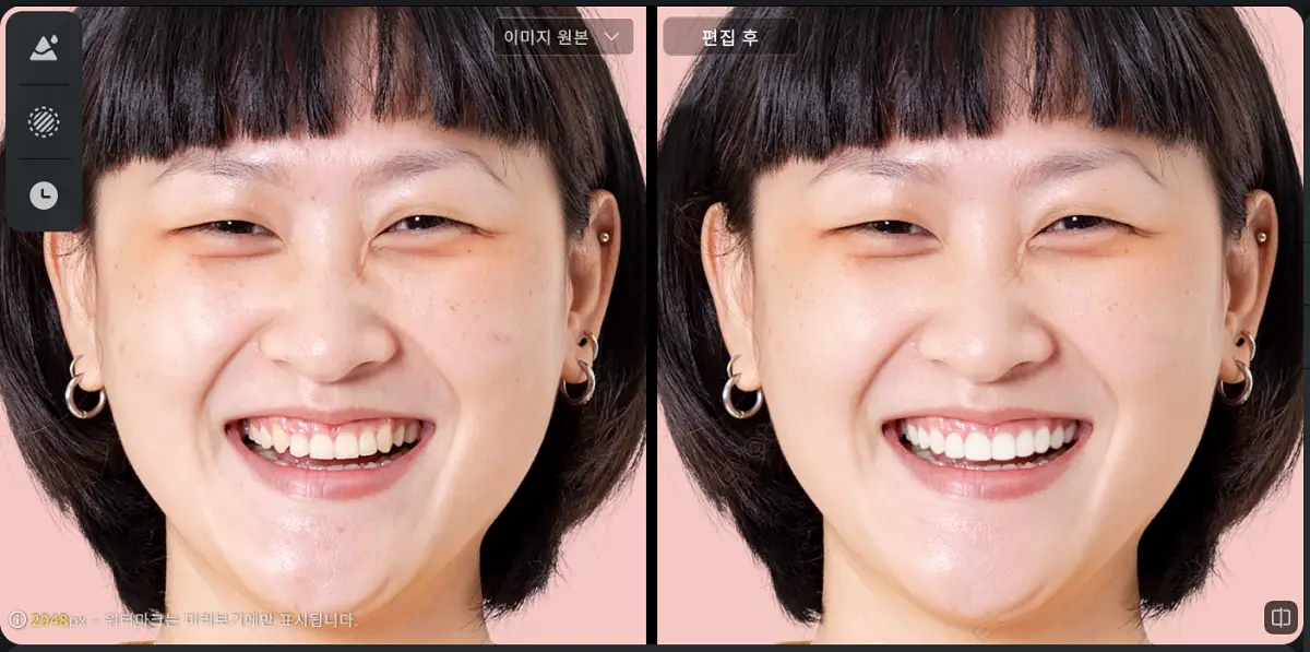 치아 색 균형 보정 치아 얼룩 제거 사진