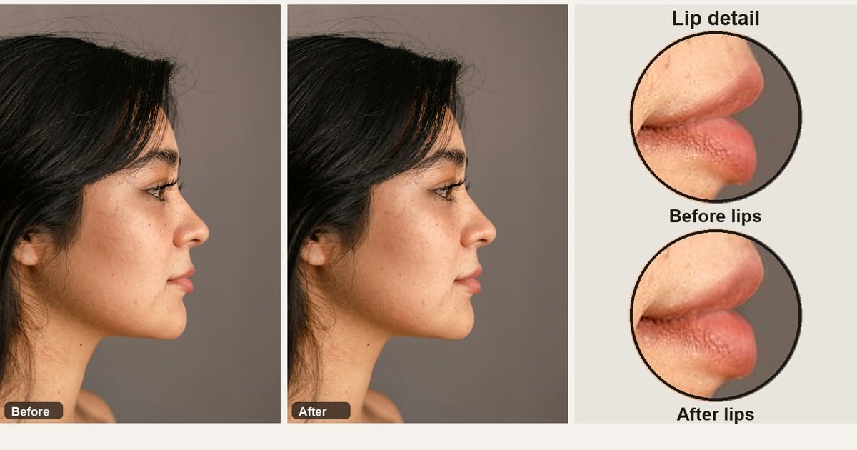 evoto app before after lip filler side profile